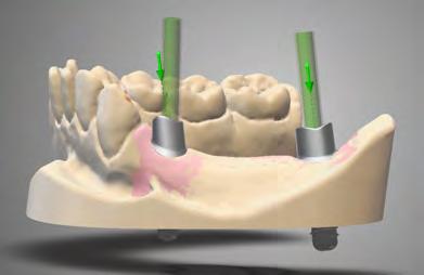 COMPONENTI SECONDARIE SU MISURA PER PONTE CEMENTATO Quando le componenti secondarie Straumann CARES sono