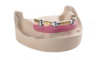 1 Barre CARES Uso previsto Le barre Straumann CARES per protesi fisse sono sovrastrutture per l applicazione diretta con resina dentale e denti acrilici prefabbricati per il trattamento dei casi di