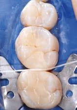 Fissaggio adesivo Descrizione passo-passo sull esempio di un inlay Condizionamento della sostanza dentaria Prova del restauro,