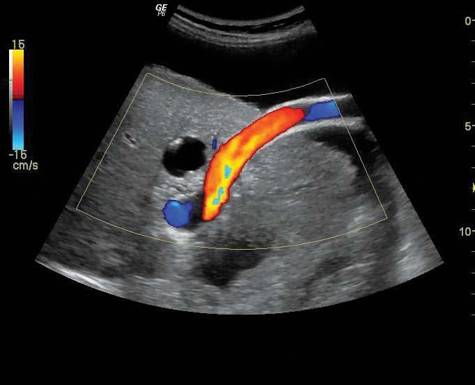 Vena porta del fegato con trasduttore 4C, ottenuta con