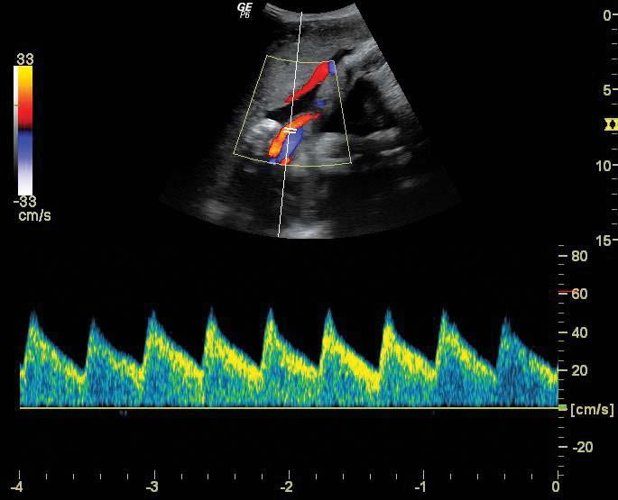 trasduttore 5CS con CrossXBeam, Harmonic Imaging e