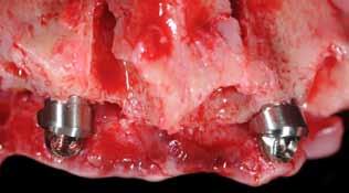 canale mandibolare; nell arcata superiore gli impianti posteriori vengono inclinati parallelamente alla parete anteriore del seno in modo da emergere nella