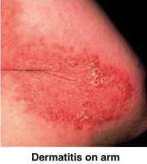 Dermatite da contatto La dermatite allergica da contatto è una comune patologia della pelle causata dalla risposta di ipersensibilità ritardata diretta contro antigeni che entrano in contatto con la