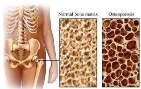 OSTEOPOROSI Malattia sistemica dello scheletro Riduzione della massa ossea per unità di volume, aumento della fragilità ossea Misurata mediante DEXA (Dual-Energy X Ray Absorptiometry); (MOC