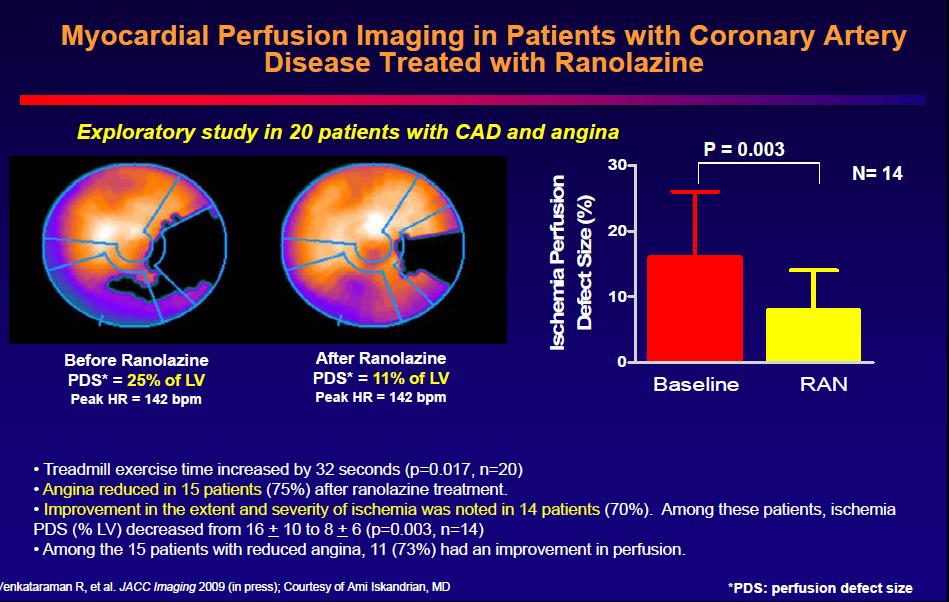 Efficacia di Ranolazina nel