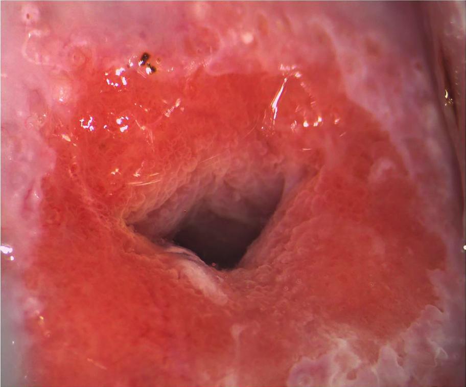 Figura 5.2. Cervice con epitelio colonnare ben evidente in sede perioriﬁziale. GSC sulla cervice con possibile estensione alla vagina (lesione des-like).