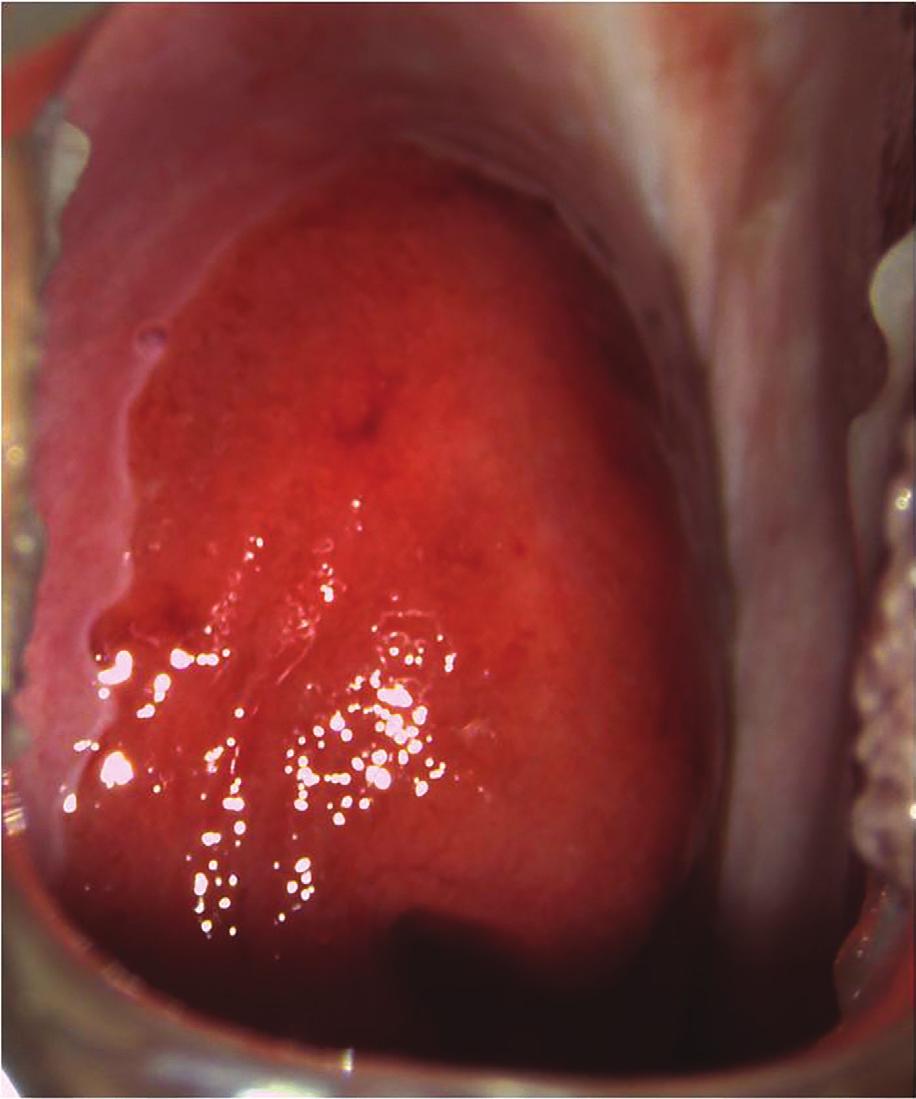 Stadi variabili di metaplasia squamosa possono essere presenti come sottili isole leggermente aceto-reattive, nel contesto della mucosa endocervicale.
