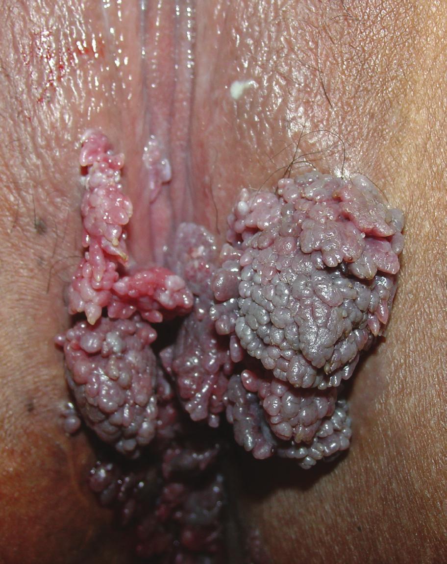 Le sedi coinvolte nelle donne possono essere la cervice, la vagina, la vulva, il meato uretrale e la regione perianale, e nel 50% dei pazienti con condilomi perianali si riscontrano condilomi