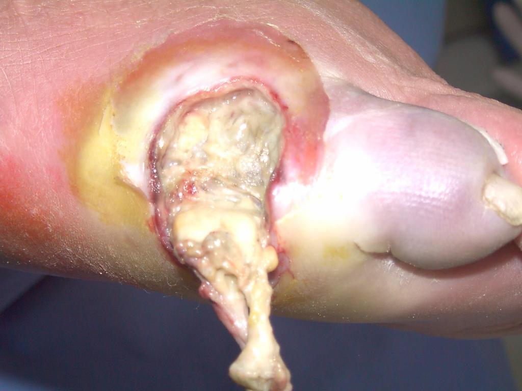 INFEZIONI DEL PIEDE DIABETICO L infezione del piede nei diabetici è una complicanza frequente e particolarmente difficile da trattare.