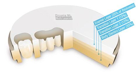 Lo strato di zirconia che simula lo smalto attenua il valore del restauro e contrasta con gli strati dentinali creando effetti cromatici tipici delle corone stratificate.