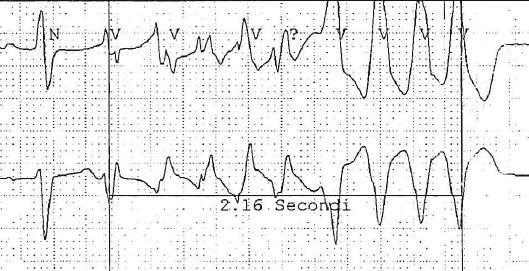 Alla telemetria, registrati due episodi di tachicardia tipo torsione di punta, di breve