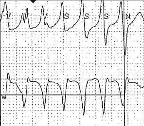 ricovero in cardiologia: diversi accertamenti (2Holter-ECG, test alla flecainide, ECG da sforzo, RMN-cuore, RMN-encefalo)