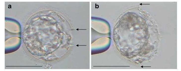 ASSISTED HATCHING Studio retrospettivo FROZEN EMBRYO TRANSFER Hiraoka et al.