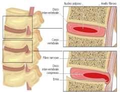 21 Malattie della colonna vertebrale: Curvature fisiologiche Curvature patologiche Ernia del disco: spostamento/scivolamento di un disco