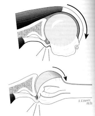 anteriore della testa omerale Dolore posteriore alla spalla Più pronunciato nella fase di