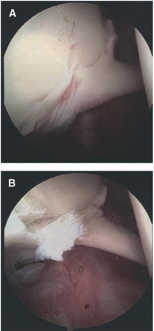 Peel back Movimento torsionale del tendine del CLBB che in extrarotazione e abduzione della spalla trasferisce un