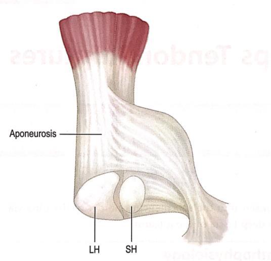 Rottura tendine distale del bicipite Anatomia: Fascio breve Fasci lungo distale Trauma in contrazione