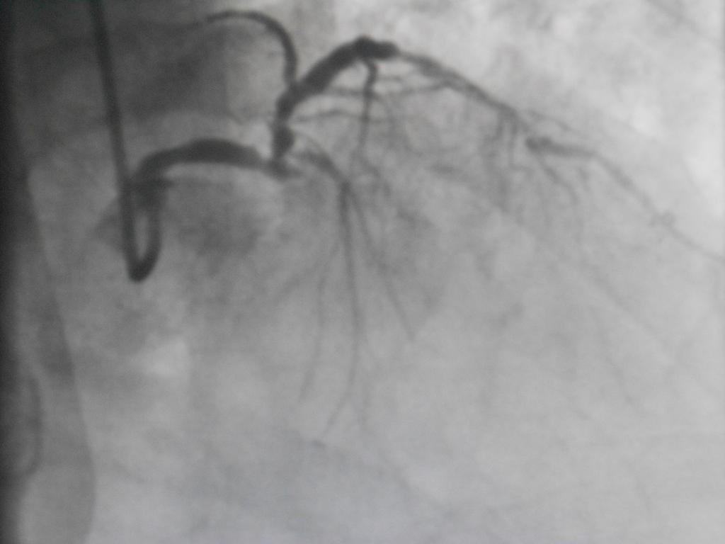 In considerazione però del tempo necessario per il trasferimento stimato attorno ai 90 minuti e persistendo angor con ECG invariato post coronarografia, si è deciso di eseguire trombolisi con