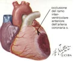 Infarto miocardico Este: 2,2 casi per 1.000 acuto (IMA) Ospedaletto Euganeo: 2,3 casi per 1.000 Az. ULSS 17: 2,3 casi per 1.