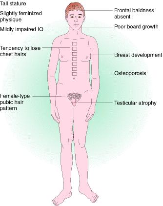 alla media pterigio del collo mammelle poco sviluppate organi sessuali interni immaturi testicoli