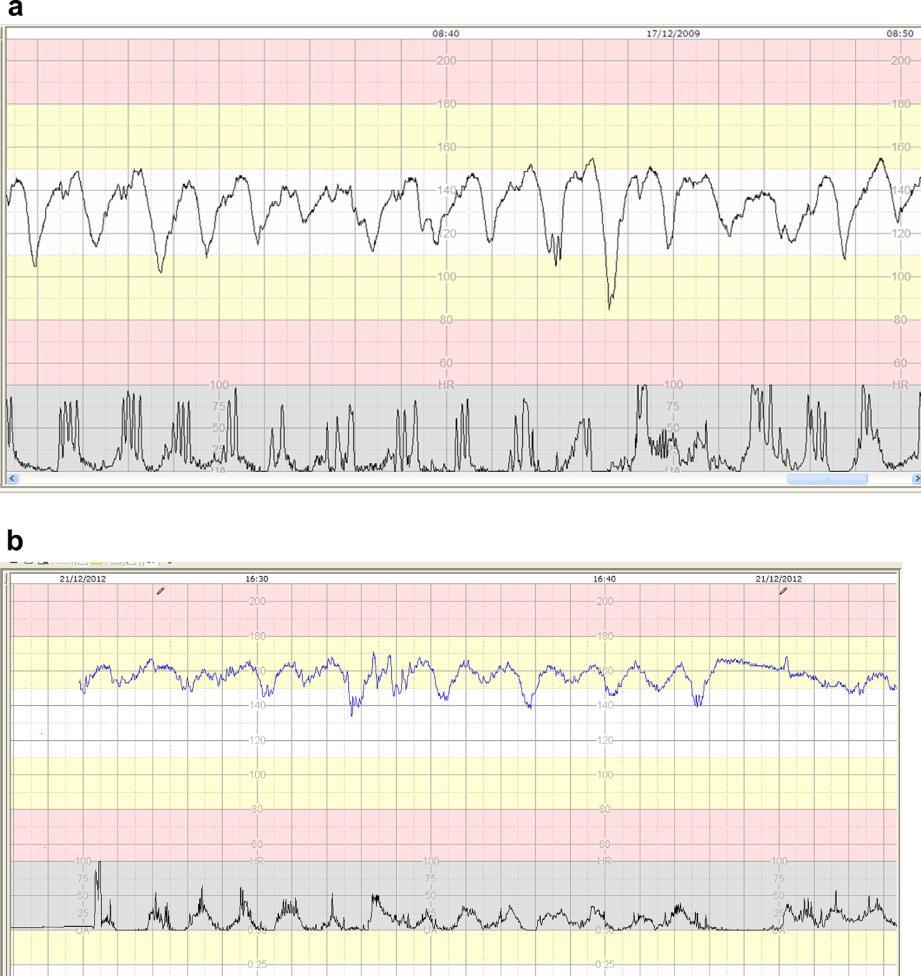 IPOSSIA SUBACUTA TACHISISTOLIA spontanea (6%...) ma, più spesso, IATROGENA DEC VAR RIP SIGNIFICATIVE (riduz > 60 bpm per > 90 ) Recovery time insuff < 60 Rapida riduz ph: 0.