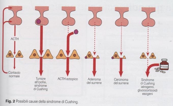 Possibili cause della sindrome di Cushing ACTH dipendente (eccesso di produzione) per adenoma ipofisario, tumori del polmone,