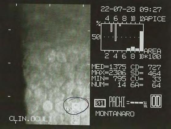 maculopatia 3 -Follow up a 9 mesi ECD: 700 cell/mm 2 BCVA: 0,02