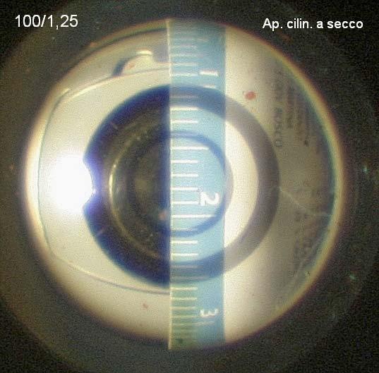 Se quest ultima è omogenea, n = 1,51, ed il valore rilevato va moltiplicato per 1,51. Apertometro piano (sopra); lettura: l = 60. NA = 0,832 1,51 = 1,256.