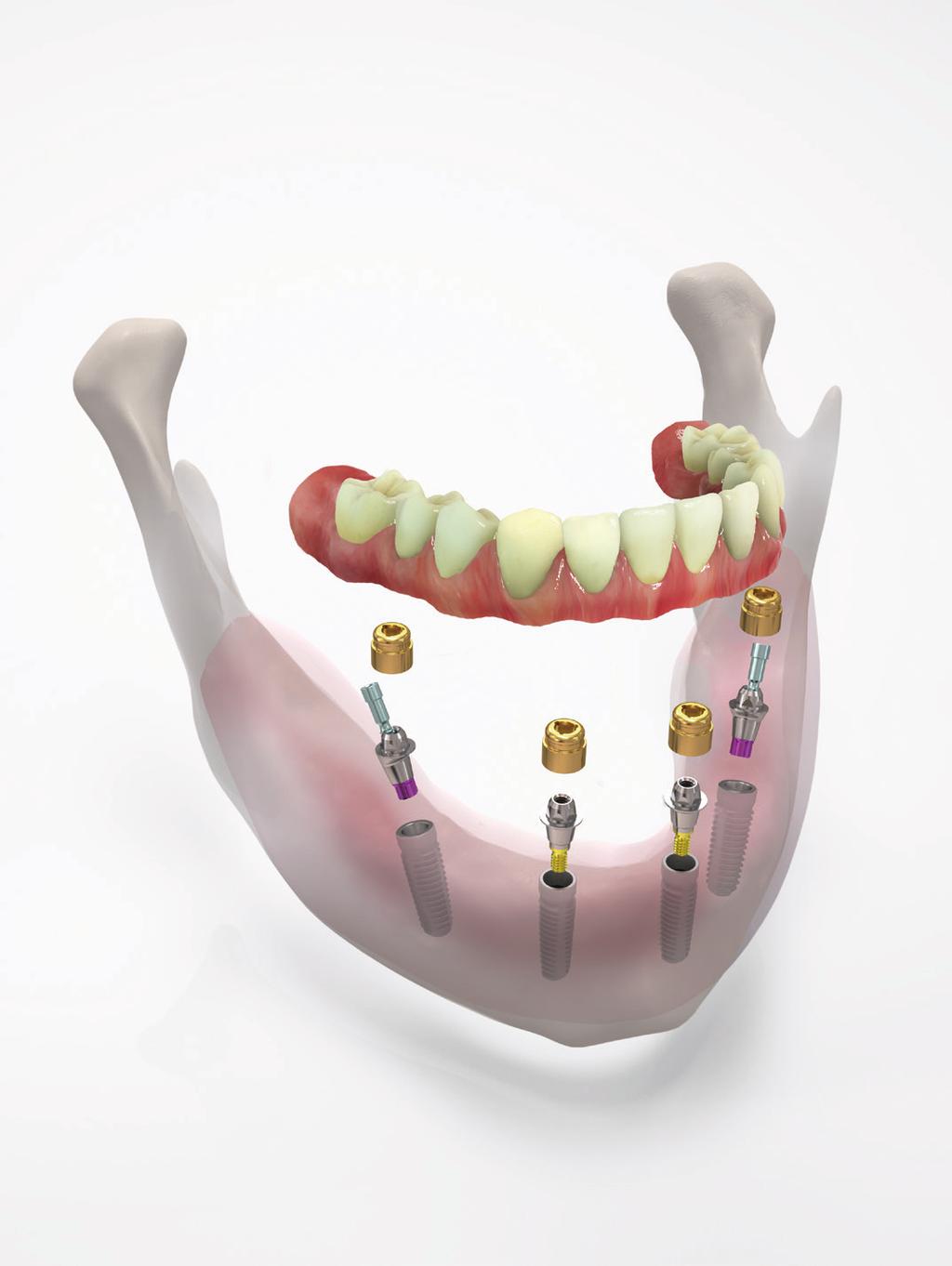 VERSATILITÀ DI UTILIZZO AL TOP. IL SISTEMA COMFOUR CONSENTE ANCHE DI REALIZZARE RICOSTRUZIONI A BARRA, CON LOCATOR E DI DENTI SINGOLI.