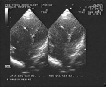 postoperatorio Disfunzione ventricolare destra Insufficienza tricuspidalica Stenosi dinamica LVOT