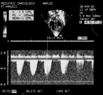 Doppler Continuo Val Polm Gradiente max 105 mmhg