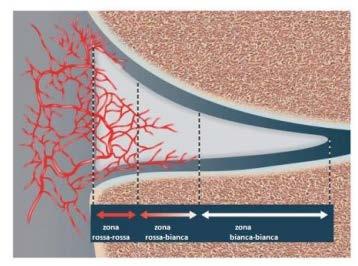 In linea generale un trauma in varismo con rotazione interna determina lesione del menisco interno. Al contrario un trauma in valgismo con rotazione esterna determina un danno del menisco esterno.