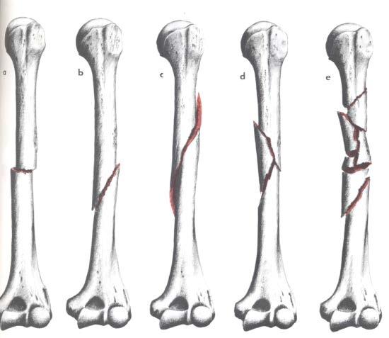 ossei) - trifocali - ecc traumatismo e a volte è impossibile valutare il numero dei frammenti Nelle ossa lunghe, in rapporto al livello scheletrico, distinguiamo: - fratture diafisarie - fratture