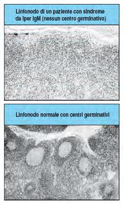 I pazienti con sindrome da iper IgM non riescono ad attivare completamente i linfociti B Mutazioni nel gene del ligando di CD40 (CD154) localizzato sul