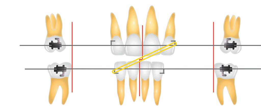 Tecnica Straight-Wire Programma Corso Base 4 INCONTRO Le fasi del trattamento ortodontico Correzione di classe e chiusura degli spazi SEQUENZA DEGLI ARCHI Tecnica Straight-Wire tradizionale vs