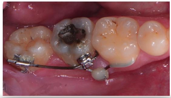 pre-protesica GESTIONE DEL SETTORE POSTERIORE Uprighting e intrusione molare GESTIONE DEL