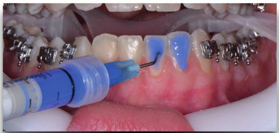 Tecnica Straight-Wire Programma Corso Base 2 INCONTRO La pianificazione del trattamento Il trattamento ortodontico IL