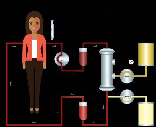 TERAPIA-1 Plasma exchange che consiste nella combinazione di plasmaferesi ed infusione di PFC, steroide ad alti