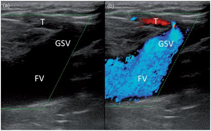 VALUTAZIONE DELLA COMPETENZA DELLA VALVOLA ILIACA Iliac valve competence scanning: (a) longitudinal section of the iliac vein just above the SFJ.