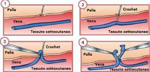FLEBECTOMIA (MULLER, ASVAL) La flebectomia è la rimozione di una vena attraverso una piccola incisione in anestesia locale.