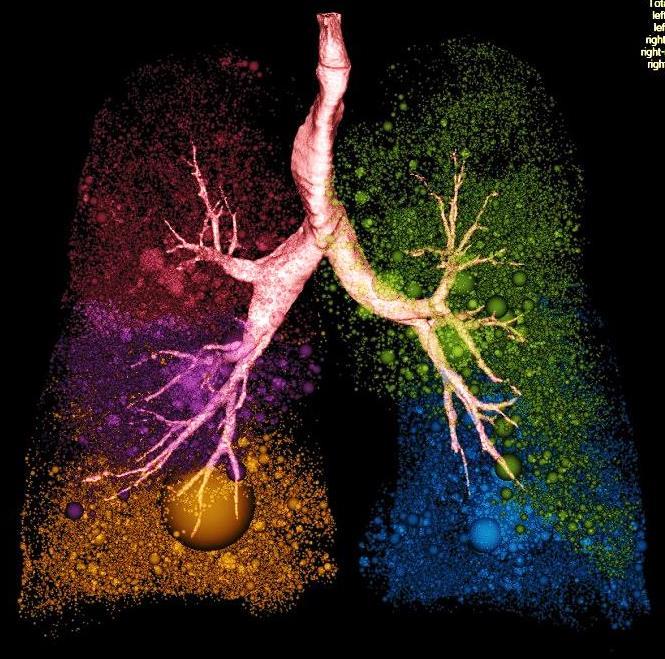 Emphysema