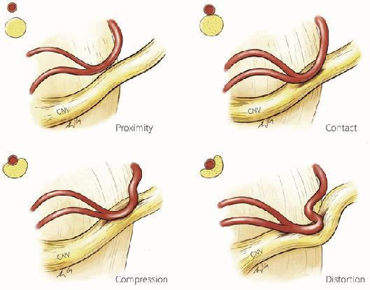 Un arteria comprime il nervo pulsazioni ripetute microtraumi danneggiano il rivestimento