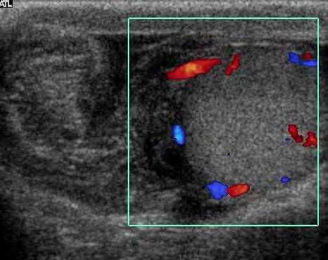 Torsione testicolare Ecocolor Doppler Problema diagnostico I: la presenza di flussi intratesticolari non esclude la torsione Doppler pulsato Sinistro (Torsione di basso