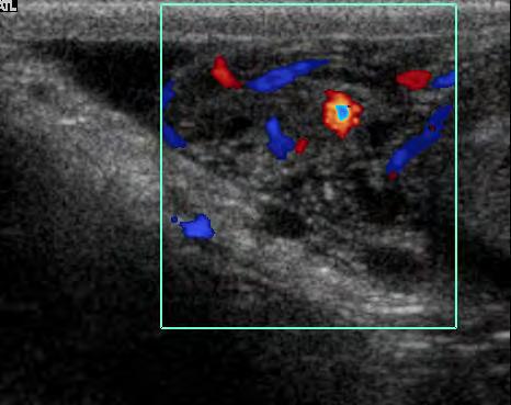 Inversione rispetto del al flusso diastolico Ingorgo testicolo venoso controlaterale e quindi occlusione Torsione del venosa con arterie funicolo ancora spermatico pervie