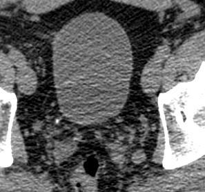 Radiol 2001 Singh S, Pediatr Surg 2003 Dogra VS, Radiology 2003 Tillett JW,