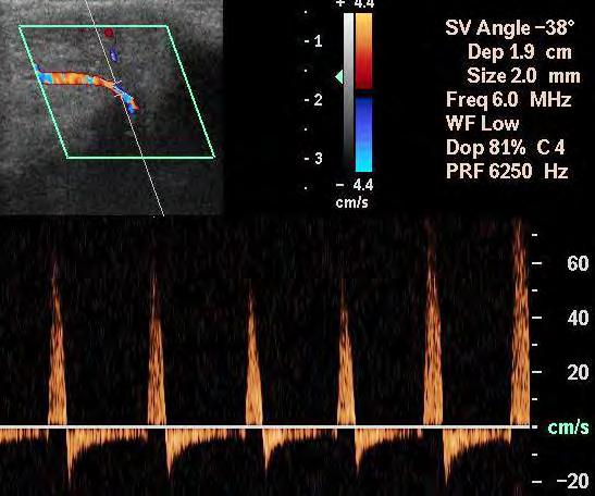 idiopatico in Risoluzione Fibrosi progressiva