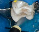 Pretrattamento della preparazione ed applicazione dell adesivo Applicare l acido fosforico (p.es. Total Etch) prima sullo smalto preparato, poi sulla dentina.