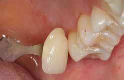 Presa del colore Presa del colore sul dente naturale Dopo la detersione del dente avviene la determinazione del colore dentale tramite scala colori sul dente non ancora preparato, oppure sui denti