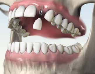 Contemporaneamente, il dente antagonista cresce perché non incontra più alcuna resistenza durante la masticazione.