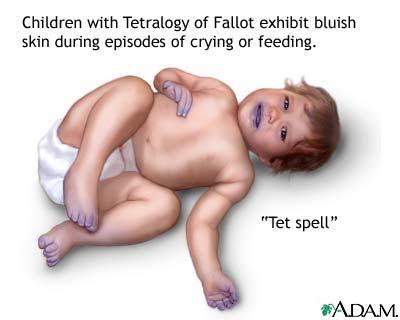Tetralogy of Fallot Clinica ESAME OBIETTIVO